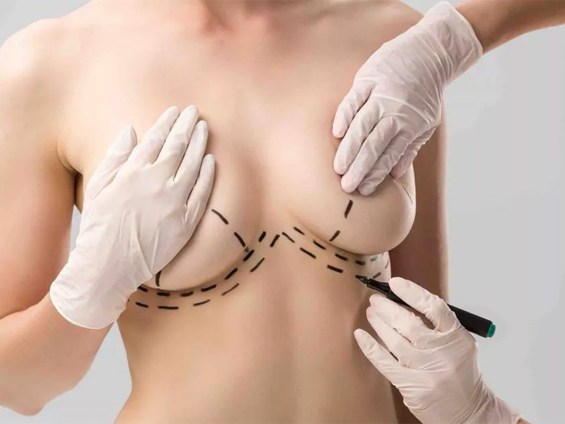 Breast Reduction Aesthetics4 Bruststraffung Ästhetik